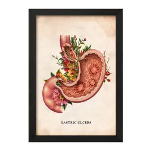 تابلو بیماری زخم معده (Gastric Ulcers)