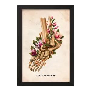 تابلو شکستگی مچ پا (Ankle Fracture)